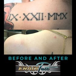 EradiTatt Tattoo Removal of St. Petersburg