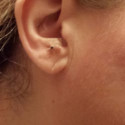 Austin Natural Healing Center - Seeding in the ear I know it looks a little weird but it really works