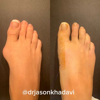 Jason Khadavi, DPM - A beautiful bunion surgery, which will have the patient back to normal activities in no time. - Podiatrists Near Me - Encino, California Jason Khadavi, DPM - A beautiful bunion surgery, which will have the patient back to normal activities in no time. - Podiatrists Near Me - Encino, California