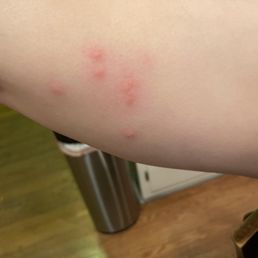 This was the biggest and itchiest cluster of bites that I received at this hotel. So many!