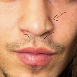 Jonathan Pontell, M.D., F.A.C.S - You can see the unnatural straight depression that weren't there before and both nostrils were done with a different shape and a bit crooked