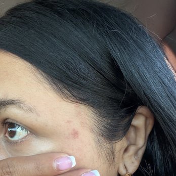 Mishal Sahdev Beauty Studio - Chemical burn - Waxing Near Me - Sunnyvale, California