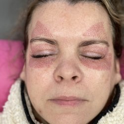 Fibroblast eye lift package!