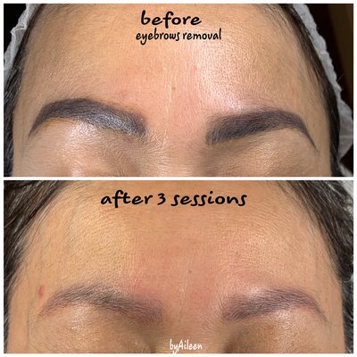 Tattoo Removal - These beautiful client wants to ensure i can deliver the best quality work for them. The result looks Amazing :)