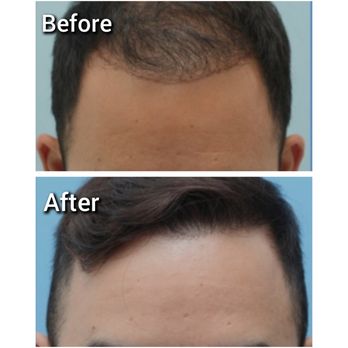 NewDerm - Hair Restoration - Hair Loss Centers Near Me - Encino, California NewDerm - Hair Restoration - Hair Loss Centers Near Me - Encino, California
