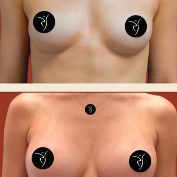Ridgewood Plastic Surgery - Breast Augmentation - Plastic Surgeons Near Me - Queens, New York