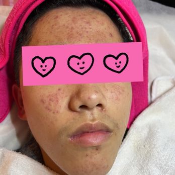 Serenity Beauty Facial - Before treatment #1 - Skin Care Near Me - Arcadia, California