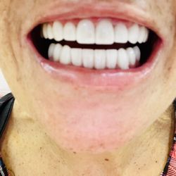 Sedation Dental Spa of South Florida - My teeth done in Colombia for 90% less!!!