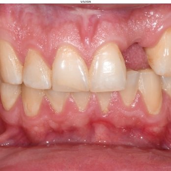Aspen Dental - Palm Harbor, FL - After treatment. - General Dentistry Near Me - Palm Harbor, Florida Aspen Dental - Palm Harbor, FL - After treatment. - General Dentistry Near Me - Palm Harbor, Florida