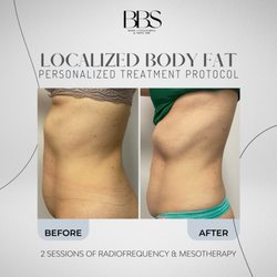 Brazilian Beauty Spa - 2 sessions of radiofrequency and mesotherapy