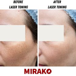 Mirako Spa - Garden Grove - Laser Toning - Patient Result