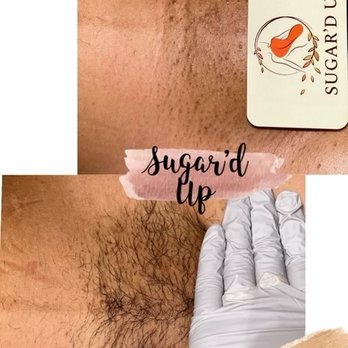 Sugar’d Up - Before after Brazilian - Sugaring Near Me - New York, New York Sugar’d Up - Before after Brazilian - Sugaring Near Me - New York, New York