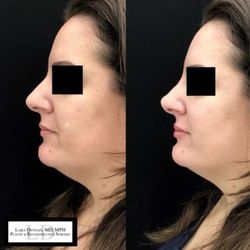 Lara Devgan, MD - Plastic & Reconstructive Surgery - Before/After