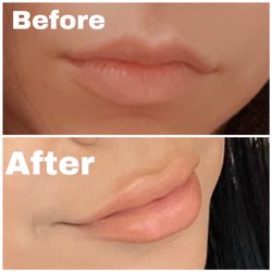 VIP Aesthetic Center - Lip filler