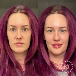 Glam Rx Aesthetics - Lip filler to balance the face, immediately after Mega Glam Lip service (Provider: Shelby Cooper)