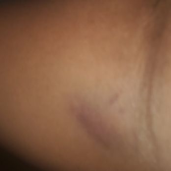 Forward Oral Surgery - Pics of my arm the very next day after visiting the office on Friday.... - Oral Surgeons Near Me - Floral Park, New York Forward Oral Surgery - Pics of my arm the very next day after visiting the office on Friday.... - Oral Surgeons Near Me - Floral Park, New York