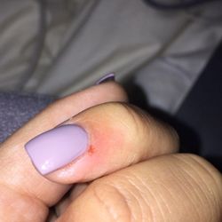 Cuticle Corner - The cut (now healed) that bled at the time