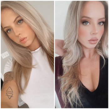CaptivatingU Med Spa - My before and after Juvederm Ultra XC. - Skin Care Near Me - W Chester, Ohio CaptivatingU Med Spa - My before and after Juvederm Ultra XC. - Skin Care Near Me - W Chester, Ohio
