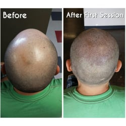Utah Scalp Micropigmentation Center - Scalp Micropigmention, before and after first treatment.