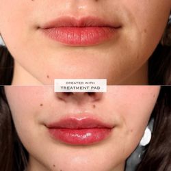 Michelle Cote, PA-C at Etoile Aesthetics SD - Lips before and after