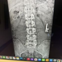 Clearview Chiropractic - Curved spine