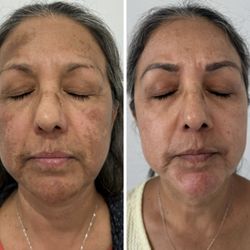 Honeys Skincare - Hyperpigmentation Treatment
