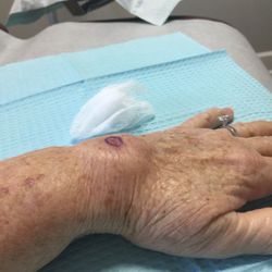 Robert L Chen, MD - Acacia Dermatology - Hand just before removal.