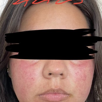Skin By Char - 2/2/23 rash came back - Acne Treatment Near Me - Westminster, California Skin By Char - 2/2/23 rash came back - Acne Treatment Near Me - Westminster, California