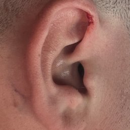 Ear cut by barber