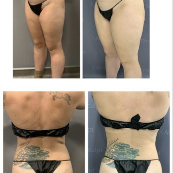 AirSculpt - Charlotte - Cosmetic Surgeons Near Me - Charlotte, North Carolina AirSculpt - Charlotte - Cosmetic Surgeons Near Me - Charlotte, North Carolina