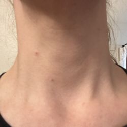Classic Complexion Aesthetics - 2 cherry angiomas removed on my neck