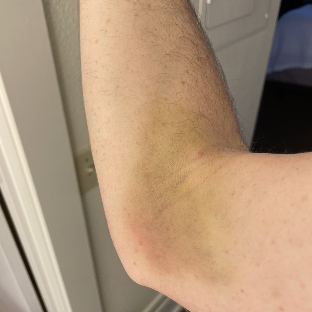 Hydration Spark - Arm - IV Hydration Near Me - Cleveland, Ohio Hydration Spark - Arm - IV Hydration Near Me - Cleveland, Ohio