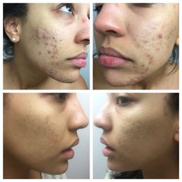 Six months and five facials with Allison apart. Such a world of difference! Six months and five facials with Allison apart. Such a world of difference!