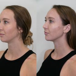Facial Balancing Before and After at Aloha Med Spa