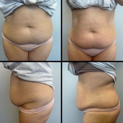 Body Sculpting Scv - Before and after first session.