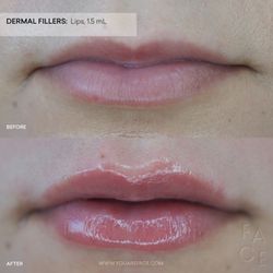At FACE, Nurse Desiree uses precise techniques to deliver natural-looking lip filler results that enhance your beauty without overdoing it.