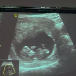 Baby at 10 weeks 5 days Baby at 10 weeks 5 days