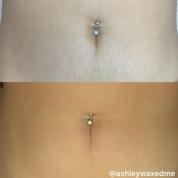 Ashley Waxed Me - Stretch Mark Service $130 - Waxing Near Me - El Dorado Hills, California Ashley Waxed Me - Stretch Mark Service $130 - Waxing Near Me - El Dorado Hills, California