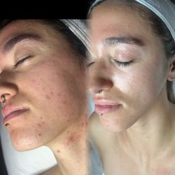 C Spa & Beauty - After 3 months of Acne clear skin Program !