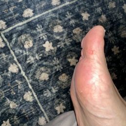 Chunk taken out of my skin by man doing my pedicure with electric foot scrub