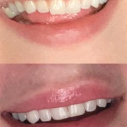 Before and after Before and after