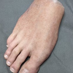 Medical Art Prosthetics - Prosthetic foot