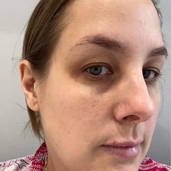 LaserAway - Before - yikes! - Tattoo Removal Near Me - Washington DC, District of Columbia