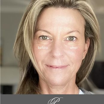 Perceptions Aesthetic Spa - Have you tried the Upneeq one eye challenge? Come and see the transformation! - Laser Hair Removal Near Me - Fair Oaks, California