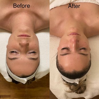Elite Facials - Microdermabrasion with Chemical add on - before and after - Skin Care Near Me - Los Angeles, California Elite Facials - Microdermabrasion with Chemical add on - before and after - Skin Care Near Me - Los Angeles, California
