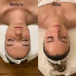 Elite Facials - Microdermabrasion with Chemical add on - before and after