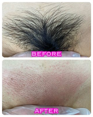 waxing results - Hard wax hair removal is a great option because it's less painful, good for sensitive skin, and can remove coarse hair. Plus, it can last longer and is easy to clean up. It's especially good for larger areas of the body like legs and arms. Give it a try!