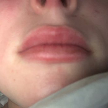 Skinjectables Anti Aging Bar - My injections that are outside my lip - Medical Spas Near Me - Tucson, Arizona Skinjectables Anti Aging Bar - My injections that are outside my lip - Medical Spas Near Me - Tucson, Arizona