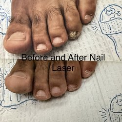 Michael R. Cook, Podiatry - Before and after nail laser treatments