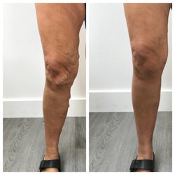 Ivan Brooks, MD - Beverly Hills Vein Institute - Post evlt and varithena